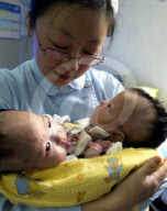 China Conjoined Twins in Shanghai