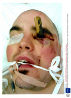 Policeman John Nash gets 6 inch stick stuck in his eye while chasing a suspect, Rochdale, Britain - 19 Dec 2008