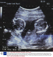 Women gives birth to twins two days apart, Sunderland, Britain - Mar 2009