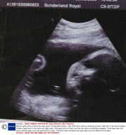 Women gives birth to twins two days apart, Sunderland, Britain - Mar 2009