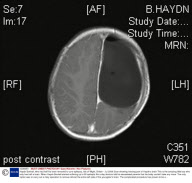 Haydn Boxhall, who had half his brain removed to cure epilepsy, Isle of Wight, Britain - Jul 2009