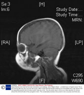 Haydn Boxhall, who had half his brain removed to cure epilepsy, Isle of Wight, Britain - Jul 2009