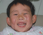 Four-year-old boy gets scissors impaled in face after fall, Qinglong town, Qinghuangdao, China - 21 Mar 2010