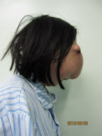 Girl awaits surgery to remove massive tumour distorting her facial features, Lishui, Zhejiang province, China - 06 Apr 2010