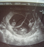 Gran delivers her own triplet grandchildren, Norwich, Britain - Nov 2009