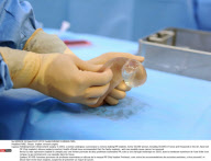 PARIS : Breast  implant removal surgery