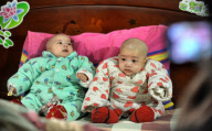  CHINA CHANGSHA CONJOINED TWINS SEPARATION 