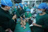  CHINA CHANGSHA CONJOINED TWINS SEPARATION 
