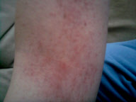 Allergische Reaktion auf Haarfärbemittel