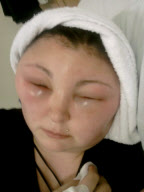 Allergische Reaktion auf Haarfärbemittel