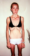 Former anorexic Harriet Smith who is planning to run the London Marathon, Britain - 22 Feb 2012