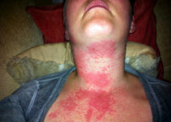 Britin reagiert allergisch auf ihr iPhone 4