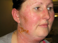 Britin reagiert allergisch auf ihr iPhone 4