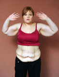 Women left with rolls of excess skin claims she felt happier and sexier before losing 11st, Bexley, London, Britain - 20 Feb 2012