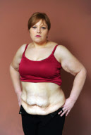 Women left with rolls of excess skin claims she felt happier and sexier before losing 11st, Bexley, London, Britain - 20 Feb 2012
