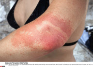 FRANCE: The jellyfish are invading the coasts