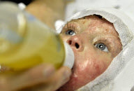 3-year-old who suffered 80% burns recovers after receives groundbreaking artificially-grown 'cloned' skin grafts, South Africa - 26 Jun 2012