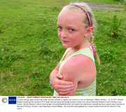 10-year-old girl gets sunburned after school refuses to apply sun cream on her in Swansea, Wales, Britain - 12 Jul 2011