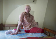 PORTRAIT: Tanzania - Albinos werden verstossen und verletzt