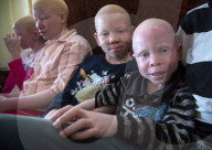 PORTRAIT: Tanzania - Albinos werden verstossen und verletzt