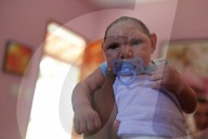 NEWS - Zika Virus: 1581 Babys mit Mikrozephalie behinderung seit Oktober 2015 