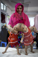 FEATURE - Siamesische ZwillingsmÃ¤dchen im Spital von Dhaka