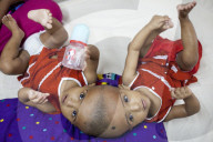 FEATURE - Siamesische ZwillingsmÃ¤dchen im Spital von Dhaka