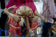 FEATURE - Siamesische ZwillingsmÃ¤dchen im Spital von Dhaka