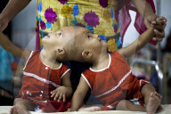 FEATURE - Siamesische ZwillingsmÃ¤dchen im Spital von Dhaka