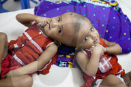 FEATURE - Siamesische ZwillingsmÃ¤dchen im Spital von Dhaka