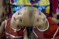FEATURE - Siamesische ZwillingsmÃ¤dchen im Spital von Dhaka