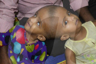 FEATURE - Bangladesch: Siamesische Zwillinge Rabeya und Rokeya Islam 1 Jahr alt
