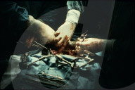 Operation mit 'Octopus'-Hilfsgerät 1980