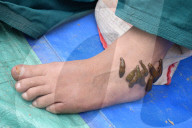 FEATURE - Blutegel Therapie in Indien