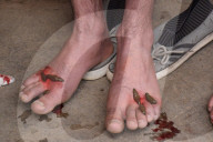 FEATURE - Blutegel Therapie in Indien
