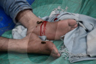 FEATURE - Blutegel Therapie in Indien