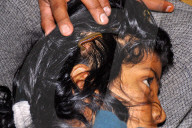 FEATURE - Blutegel Therapie in Indien