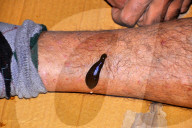 FEATURE - Blutegel Therapie in Indien