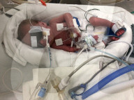 SCHICKSALE - Die Frühchen Jaxon und Axel Martin haben trotz Zwillings-Syndrom überlebt