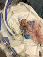 SCHICKSALE - Die Frühchen Jaxon und Axel Martin haben trotz Zwillings-Syndrom überlebt