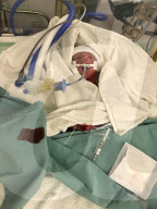 SCHICKSALE - Die Frühchen Jaxon und Axel Martin haben trotz Zwillings-Syndrom überlebt