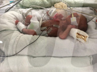 SCHICKSALE - Die Frühchen Jaxon und Axel Martin haben trotz Zwillings-Syndrom überlebt