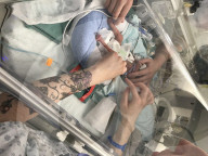 SCHICKSALE - Die Frühchen Jaxon und Axel Martin haben trotz Zwillings-Syndrom überlebt