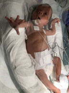 SCHICKSALE - Die Frühchen Jaxon und Axel Martin haben trotz Zwillings-Syndrom überlebt