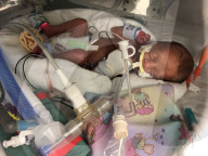 SCHICKSALE - Die Frühchen Jaxon und Axel Martin haben trotz Zwillings-Syndrom überlebt