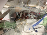 SCHICKSALE - Die Frühchen Jaxon und Axel Martin haben trotz Zwillings-Syndrom überlebt