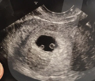 SCHICKSALE - Sepsis in der Schwangerschaft: Betroffene warnt werdende Mütter vor der Gefahr