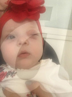 SCHICKSALE -  Retinoblastom: Nach einer Tumoroperation am Auge ist die 1-jährige Dela Rose wieder wohlauf