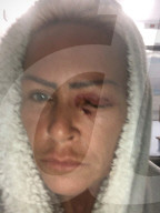 SCHICKSALE - Augenlicht in Gefahr: Ein kleiner Ratscher in die Haut verursacht bei Claire Taylor eine gefährliche Infektion