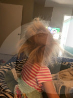SCHICKSALE - Seltene Diagnose: Zoey Freda hat unkämmbares Haar